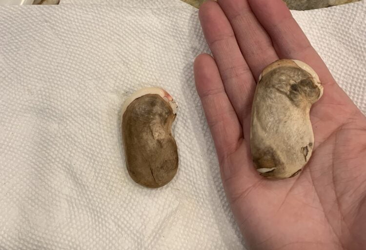 Two large mango seeds, one in the palm of someone's hand and the other lying on a white dish towel.